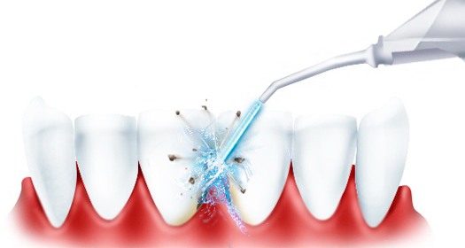  Irrigador oral