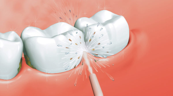  Limpieza de dientes con irrigador.