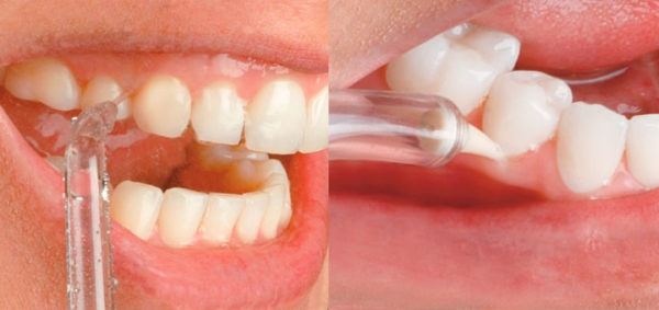  Irrigador oral