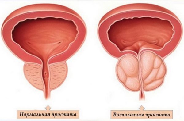  Inflamación de la próstata