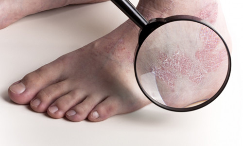  Eczema en las piernas.